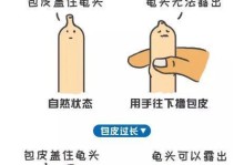 3D环扣包皮手术（拥抱新技术，重拾健康自信）