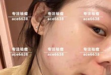 快速消除额头痘痘的有效方法（掌握关键技巧，让你的额头重现光滑）