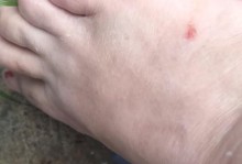 狗咬未接种疫苗会产生哪些后果？（探究狗咬未打疫苗对人类及动物的影响）